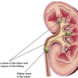 Kidney Stone Remedy